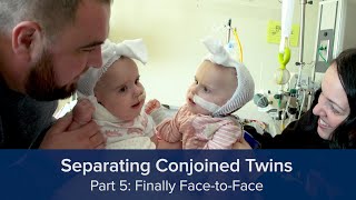 Separating Conjoined Twins Part 5 Finally FacetoFace [upl. by Elamaj]