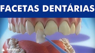 Facetas dentárias  Preparação e colocação de facetas © [upl. by Blake]