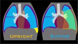 Pleural Effusion Explained by Prometheus Lionhart MD [upl. by Ferrigno]