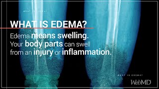 What is Edema  WebMD [upl. by Aik967]