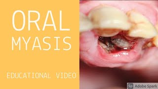 oralmyiasis maggots worms in mouth  വായിലെ പുഴുക്കൾ  oralmyiasis causes symptoms and treatment [upl. by Ahsekyt]