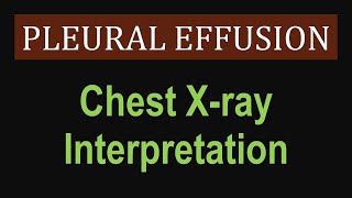 Pleural Effusion  Chest Xray Interpretation [upl. by Ivers]