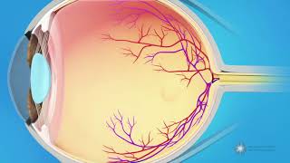 What causes a macular pucker [upl. by Barayon898]