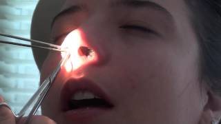 Retirada do Splint Nasal  Septoplastia [upl. by Jodee377]