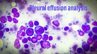 Pleural effusion analysis [upl. by Aniretac677]