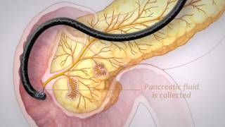 Pancreatic Cancer Screening [upl. by Cid]