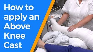 How to apply an Above Knee Cast [upl. by Des]