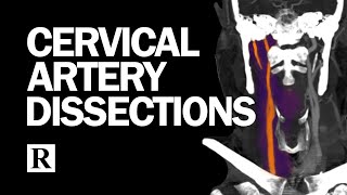 Cervical Arterial Dissections [upl. by Garibald773]