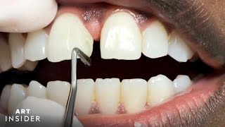 How Should a Proper Bite Fit Together Orthodontist Buffalo NY [upl. by Nibuz483]