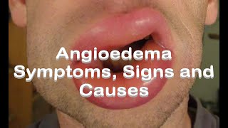 Angioedema  Symptoms Signs and Causes [upl. by Edik165]