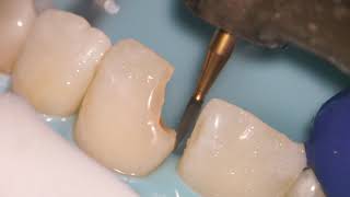 Teeth Bonding  Front tooth filling EXPLAINED [upl. by Vaclav894]