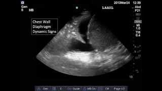 Lung and Pleural Ultrasound Interpretation [upl. by Simmons559]