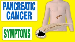 Pancreatic Cancer  All Symptoms [upl. by Yenwat567]