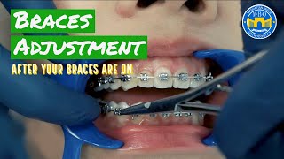 How Do Braces Straighten Teeth [upl. by Morgun]