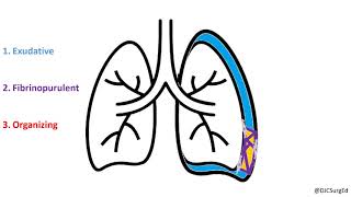 Empyema and Pleural Effusions [upl. by Eimaral]