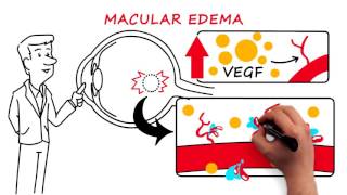 Retinal Vein Occlusion [upl. by Aihseya]