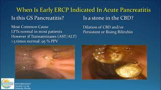 Management of Acute Pancreatitis [upl. by Hanoj251]