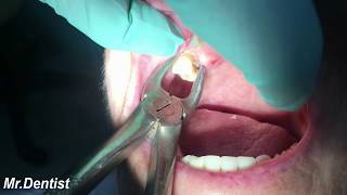 Extraction Of Molar Tooth [upl. by Faso]