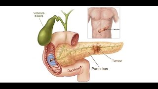 Pancreatitis  Acute and Chronic Pancreatitis Nursing Lecture Symptoms Treatment Pathophysiology [upl. by Plossl]