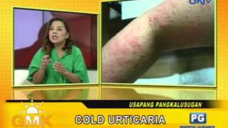 Cold Urticaria [upl. by Ball]